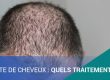 PERTE DE CHEVEUX : QUELS TRAITEMENTS ?