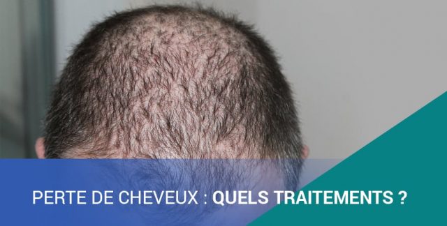 PERTE DE CHEVEUX : QUELS TRAITEMENTS ?