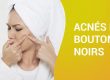 ACNÉS ET BOUTONS NOIRS