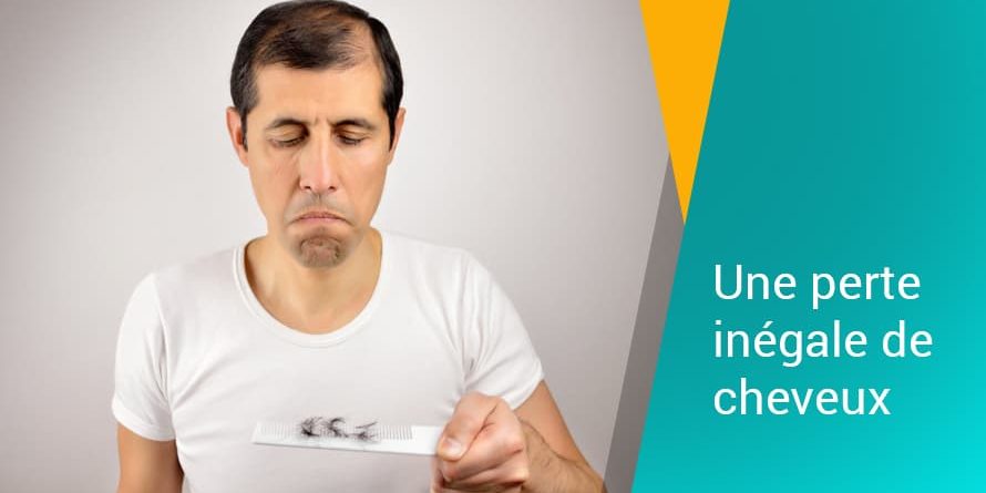 Une perte inégale de cheveux Une perte inégale de cheveux