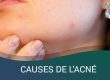 CAUSES DE L’ACNÉ