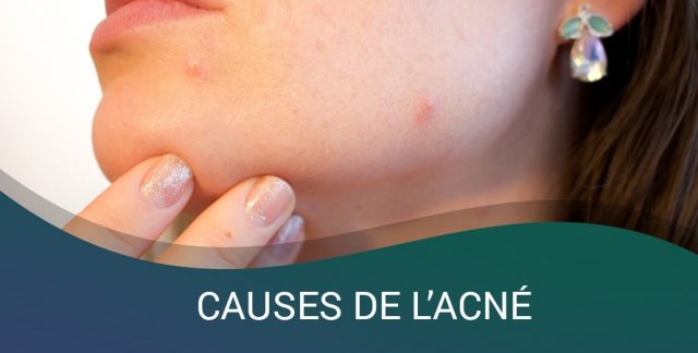 CAUSES DE L’ACNÉ CAUSES DE L’ACNÉ