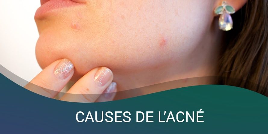 CAUSES DE L’ACNÉ CAUSES DE L’ACNÉ