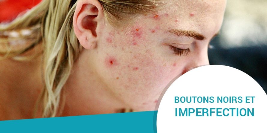 BOUTONS NOIRS ET IMPERFECTIONS BOUTONS NOIRS ET IMPERFECTIONS